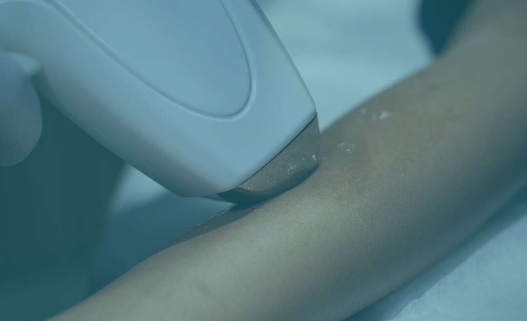 Permanent Hair Laser Reduction