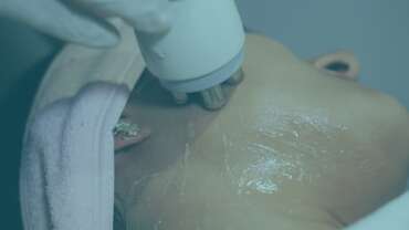 Microneedling + Radiofrequency Machine