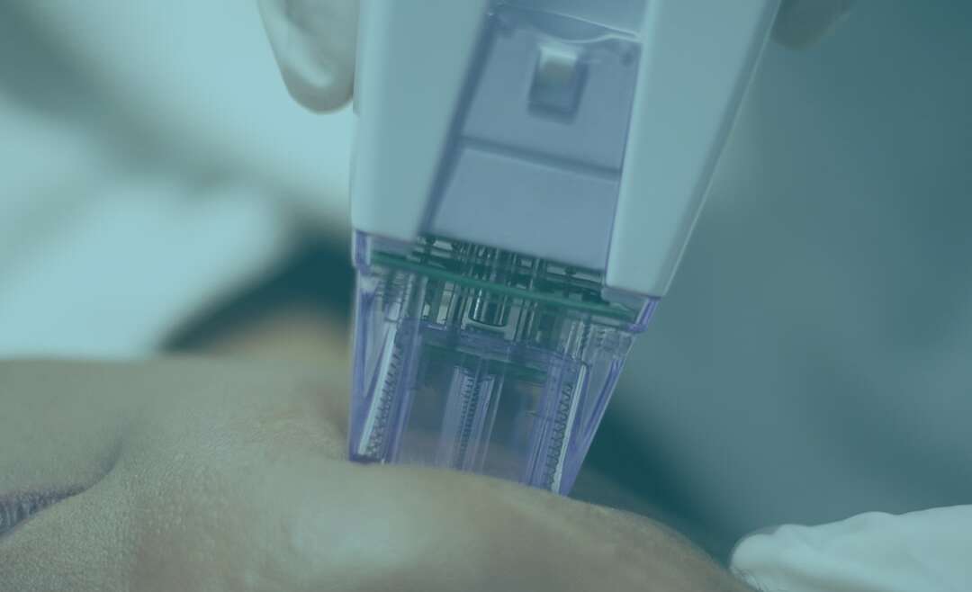 Skin Tag and Mole Removal