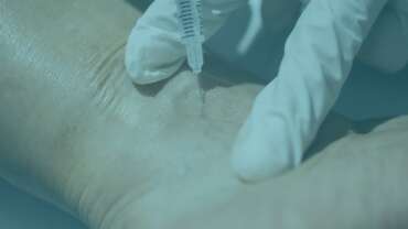 Spider Vein Treatment